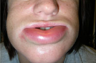 RUCONEST symptom relief