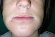 RUCONEST symptom relief