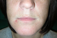 RUCONEST symptom relief